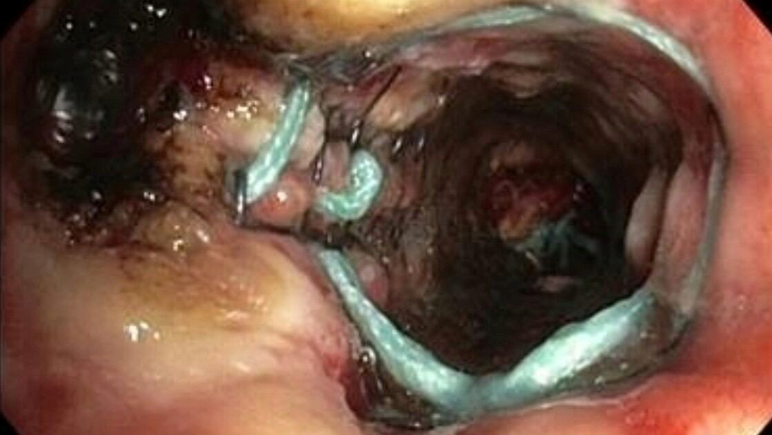 Bronchialstent