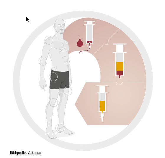 Ablauf Eigenbluttherapie