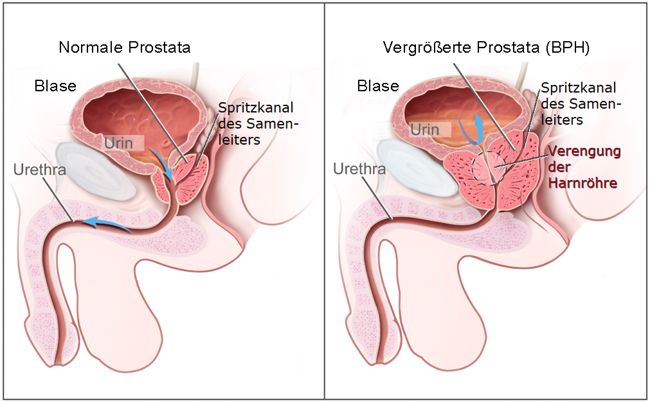 Prostatavergrösserung