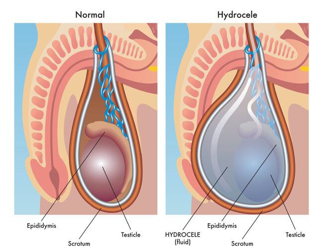 Hydrozele