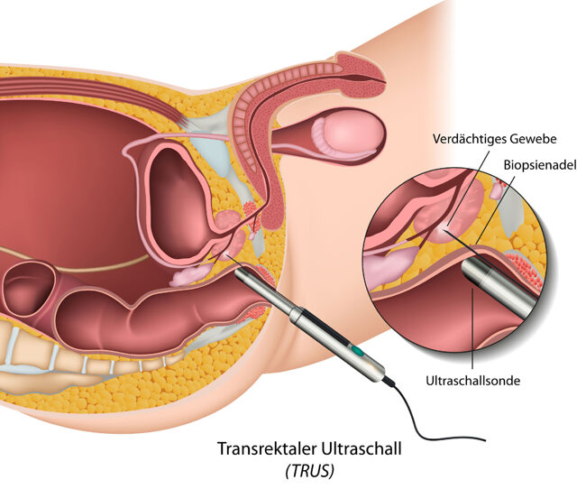 Prostatabiopsie